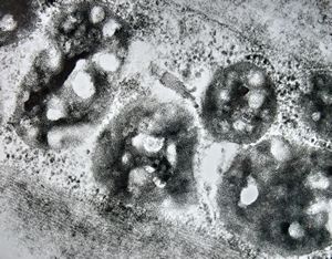F,25y. | metachromatic leukodystrophy - n. suralis F,25y. | metachromatic leukodystrophy - n. suralis